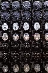 Vertical photo MRI, MRT, CT scan.image of human brain. Medical treatmant concept. Diagnosis of the disease humans head.