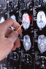 Vertical photo of a Doctor examining  MRI, MRT, CT scan image of human brain. Medical treatmant concept. Diagnosis of the disease humans head. Close up.