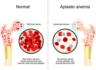 Aplastic anemia