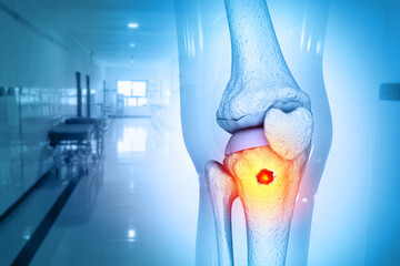 Bone cancer. Knee joint. 3d illustration