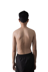 Fototapeta premium Scoliosis treatment. young man with a severe curvature of the spine isolated on gray background.