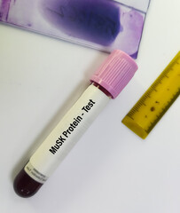 Blood sample for Muscle Specific Kinase (MuSK) protein test. Myasthenia gravis. Autoimmune disease.