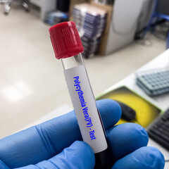 Blood sample for Polycythemia Vera (PV) test. Complete Blood Count(CBC) test.