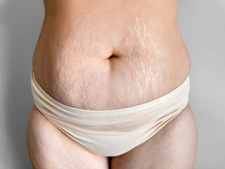 Womans midsection with stretch marks to celebrate real beauty, body positivity, and the natural...