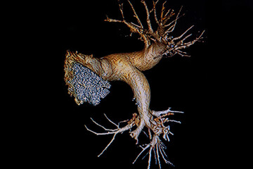 Angiotomography: Right pulmonary thromboembolic process. Medical themes