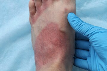 A doctor in blue gloves makes examines a redness woman's leg as result of skin burn. Foot soreness after sunburn. Dermatology problems. Inflammation sensitive skin from allergies. Thermal burn
