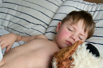 Viral disease. Measles rash on the body of the child. Allergy