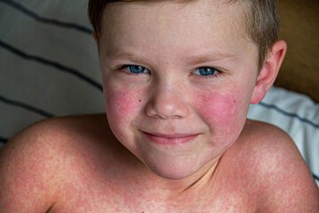 Viral disease. Measles rash on the body of the child. Allergy - obrazy, fototapety, plakaty
