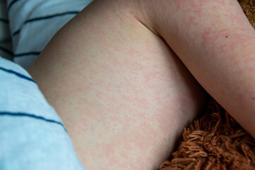 Viral disease. Measles rash on the body of the child. Allergy