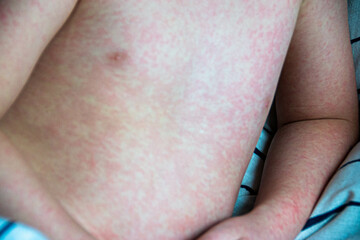 Viral disease. Measles rash on the body of the child. Allergy