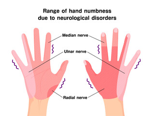 Range of hand numbness due to neurological disorders