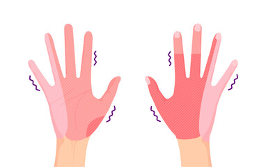 Range of hand numbness due to neurological disorders