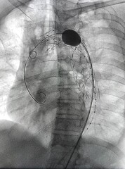 Stent graft balloon catheter was inflated after stent graft deployed at descending aorta during...