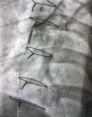 coronary angiogram showed saphenous vein graft (SVG) with balloon was inflated during percutaneous coronary intervention (PCI).