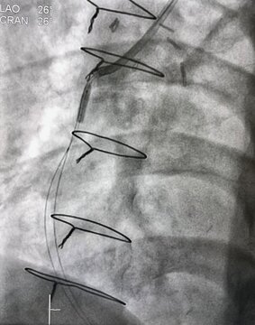 coronary angiogram showed saphenous vein graft (SVG) with balloon was inflated during percutaneous coronary intervention (PCI).