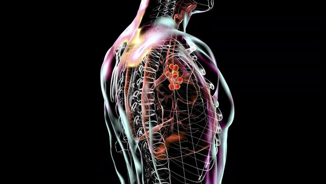 Mediastinal lymphadenitis, an inflammation of lymph nodes in the mediastinum, often associated with respiratory infections or malignancies, 3D animation.