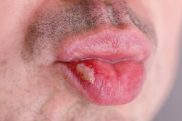Herpes virus and infection treatment. Macro Men lips. Cold sore on the lip of a middle aged male.  - obrazy, fototapety, plakaty