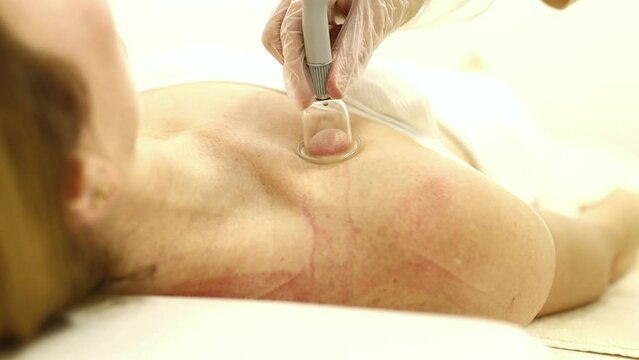 Woman Receiving Treatment for Cellulite. Slimming Vacuum Massage