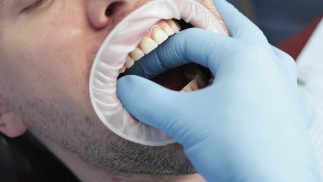 Unscrewing a healing abutment with a torque wrench, often referred to as a healing cap or gingival former. Dental implant procedure