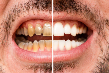 Man's teeth before and after whitening and alignment (braces). Oral care