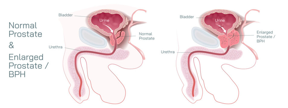 The prostate gland is located just below the bladder in men and surrounds the top portion of the tube that drains urine from the bladder or urethra vector illustration. Students study material.