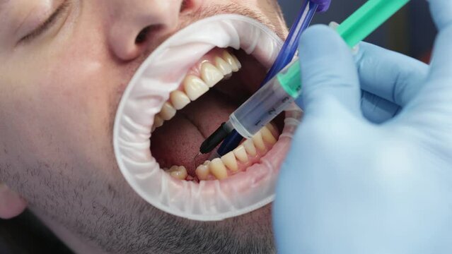 The doctor disinfects the tooth cavity with chlorhexidine from a syringe. Healthy dental care concept