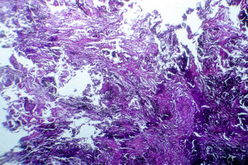 Photomicrograph of lung tissue with silicosis pathology under a microscope, revealing silica...