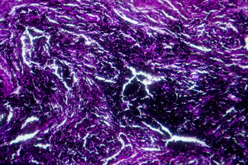 Photomicrograph of lung tissue with silicosis pathology under a microscope, revealing silica...