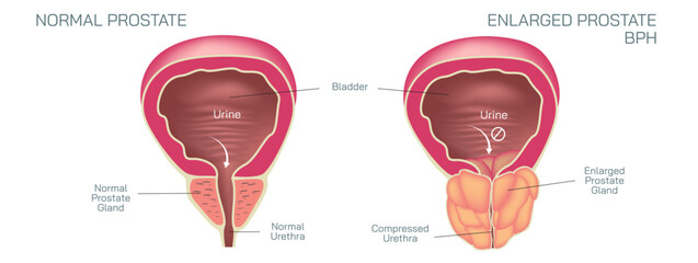 The prostate gland is located just below the bladder in men and surrounds the top portion of the tube that drains urine from the bladder or urethra vector illustration. Students study material.
