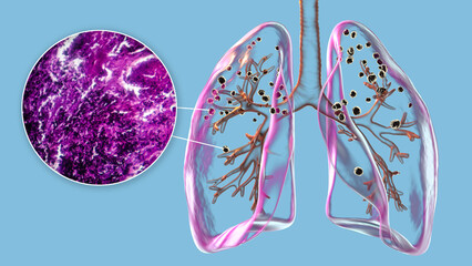 Lungs affected by silicosis, 3D illustration and micrograph