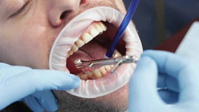 Tightening the healing abutment with a torque wrench, often referred to as a healing cap or gingival former. Dental implant procedure