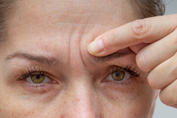 Cropped woman face pointing at wrinkles between eyebrows by finger