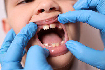They examine the oral cavity of a boy with missing baby teeth. Dentistry and dental care.