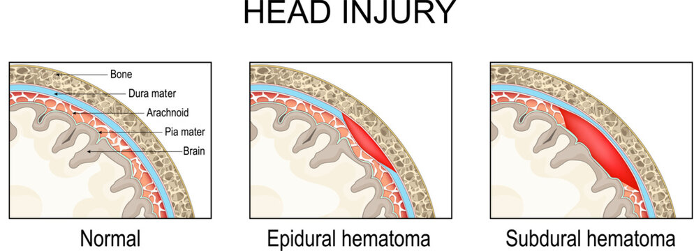 Epidural hematoma and Subdural hematoma. Traumatic brain injury