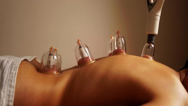 Woman getting cup therapy at spa. Chinese vacuum suction treatment for pain relief