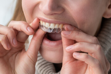 White woman wears transparent dental aligners 