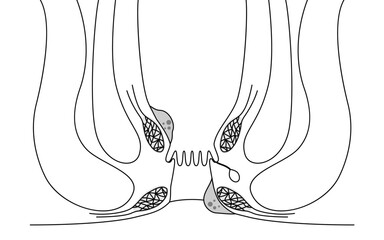 肛門の病気、痔・いぼ痔　図解イラスト、断面図