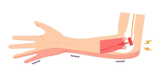 Cubital tunnel syndrome vector illustration