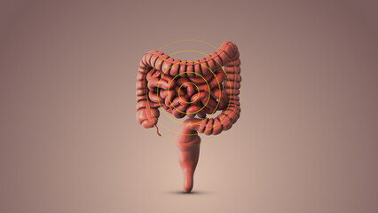 Irritable bowel syndrome medical animation