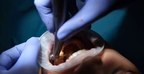 Dentist drills tooth to patient in dental chair. Dental caries treatment concept