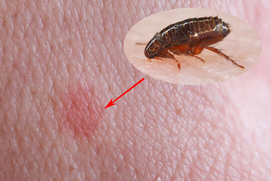 A flea biting on the skin of human hand, drinking blood. A nuisance parasite of domestic animals and humans. A carrier of disease-causing microorganisms.