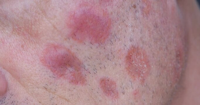 A case of cutaneous sarcoidosis on the face of a man, close up view