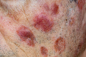 A case of cutaneous sarcoidosis on the face of a man, close up view