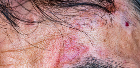 A case of cutaneous sarcoidosis on the face of a man, close up view