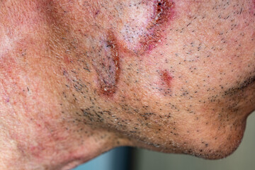 A case of cutaneous sarcoidosis on the face of a man, close up view