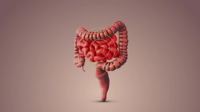 Irritable bowel syndrome medical animation