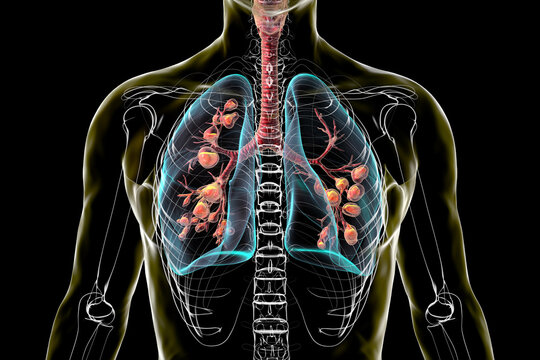 Lungs affected by cystic fibrosis, 3D illustration
