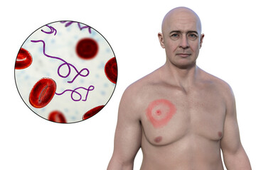 A man with erythema migrans, a characteristic rash of Lyme disease caused by Borrelia burgdorferi, 3D illustration - obrazy, fototapety, plakaty
