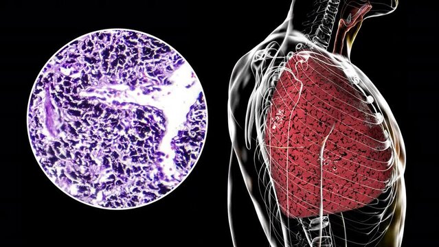 A human body revealing smoker's lungs, 3D animation and light micrograph footage. Smokers' lungs exhibit discoloration, tar deposition, and respiratory damage due to chronic exposure to tobacco smoke.