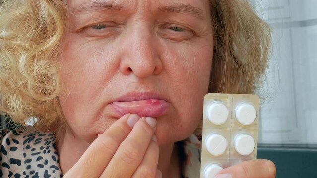 stomatitis in mouth closeup, close-up on the lip with aphthous stomatitis, treatment of inflammation of the oral mucosa, concept